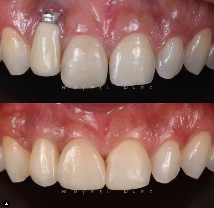 Manipulação de Tecidos Moles ao Redor de Dentes e Implantes